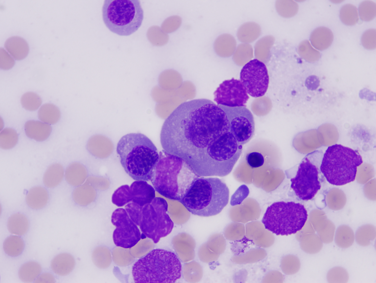 Bone marrow aspirate. Atypical erythroid precursors. 1000x
